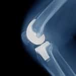 Knee Replacement Lawsuit