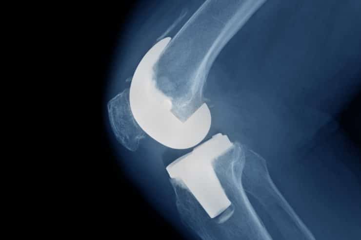 Knee Replacement Lawsuit