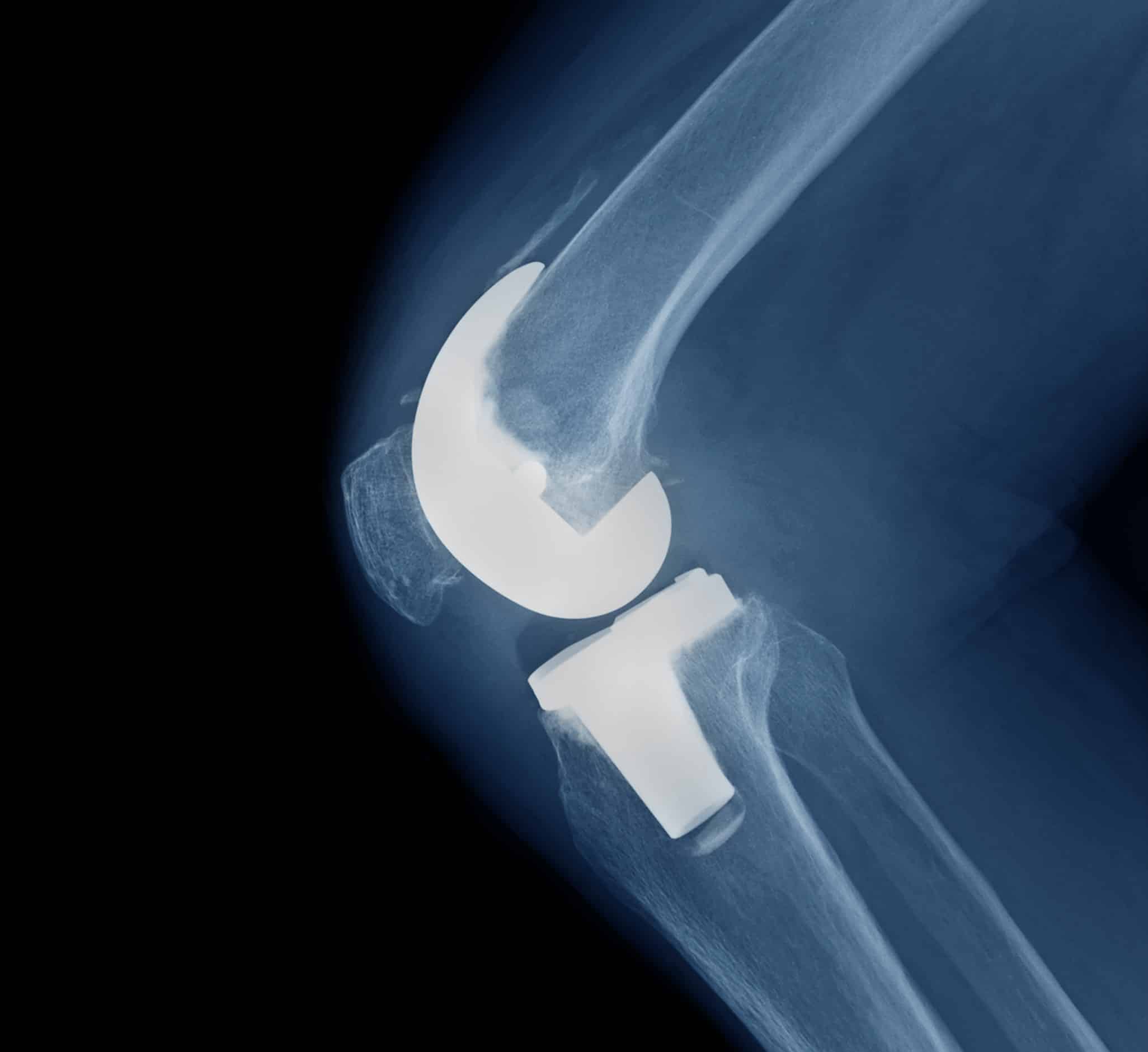 Knee Replacement Lawsuit Injury & Revision Surgeries