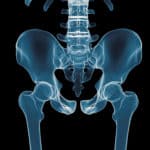 Stryker Hip Replacement Lawsuit