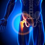 DePuy ASR Hip Replacement Lawsuit