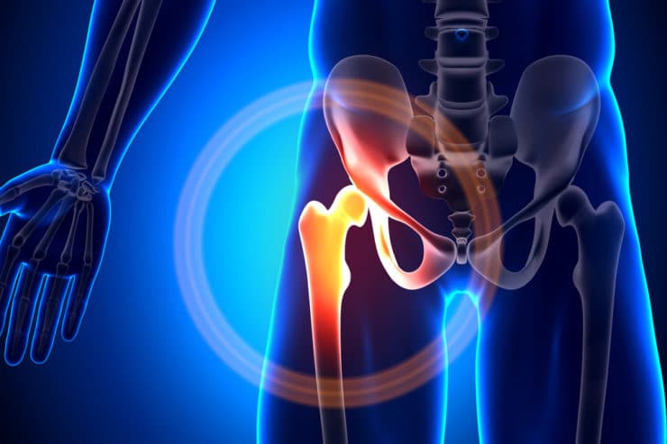 DePuy ASR Hip Replacement Lawsuit