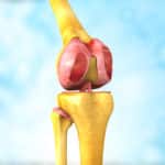 DePuy Knee Replacement Lawsuit