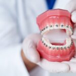 AGGA or FAGGA Dental Device Injury Lawsuit
